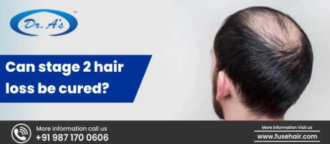 Stage 2 Hair Loss, Best Hair Transplant in India