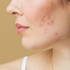 Say Goodbye to Acne: Top Treatments in Dubai