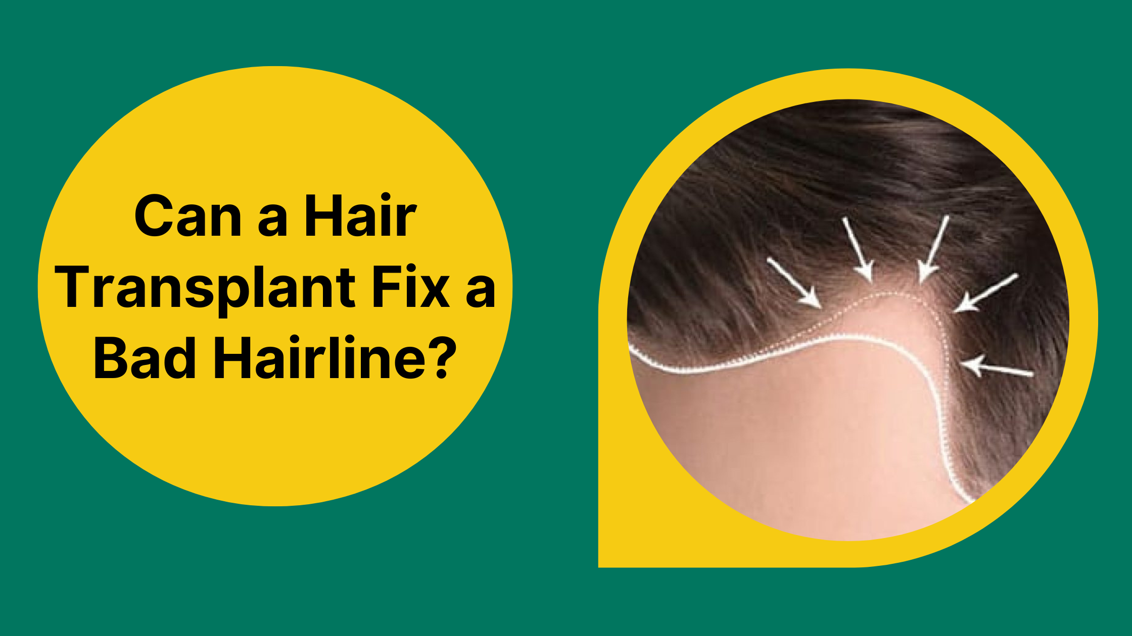 Can a Hair Transplant Fix a Bad Hairline?