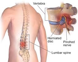 Top Muscle Relaxants for Acute Pain Relief