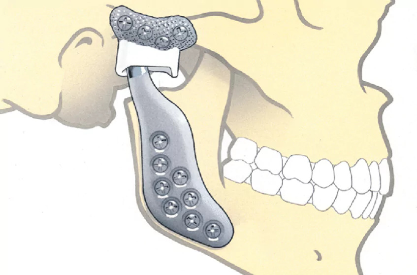 Advanced TMJ Replacement Surgery in India: A Game-Changer for Jaw Pain