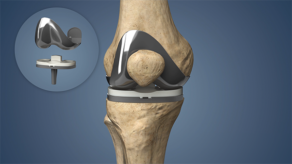 How to Manage Arthritis Pain Without Surgery