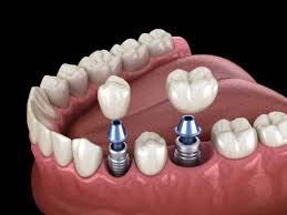 Global Dental Implants and Prosthetics Market: Innovations, Trends, and Patient-Centered Solutions