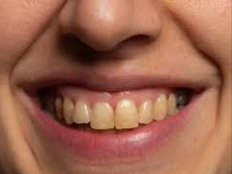 How to Get Better Teeth and Gums Using Probiotics: The Secret to a Healthier Smile