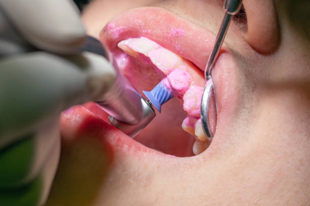 Best Clinics for Teeth Cleaning and Polishing in Riyadh