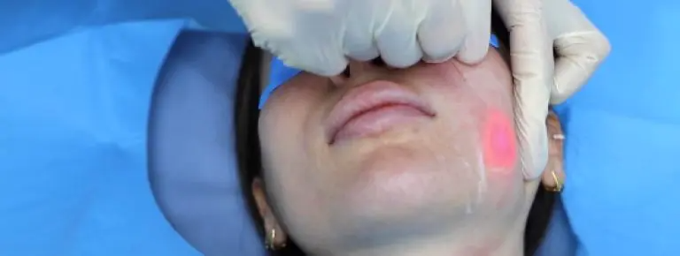 Understanding Endolift: A Step-by-Step Treatment Breakdown