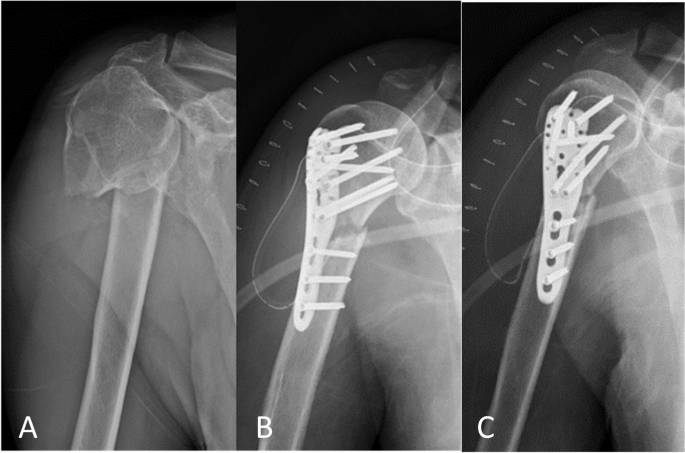 Top 7 Effective Treatments for Wrist & Shoulder Fractures: Comprehensive Guide to Recovery