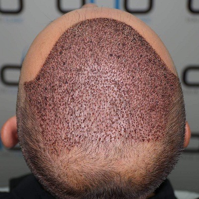 Beyond the Scalpel: Exploring Non-Surgical Hair Restoration Alternatives in Islamabad