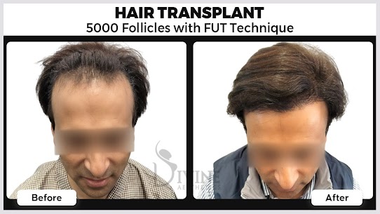 Hair Transplant in Gurgaon, Noida, and Lucknow: Everything You Need to Know
