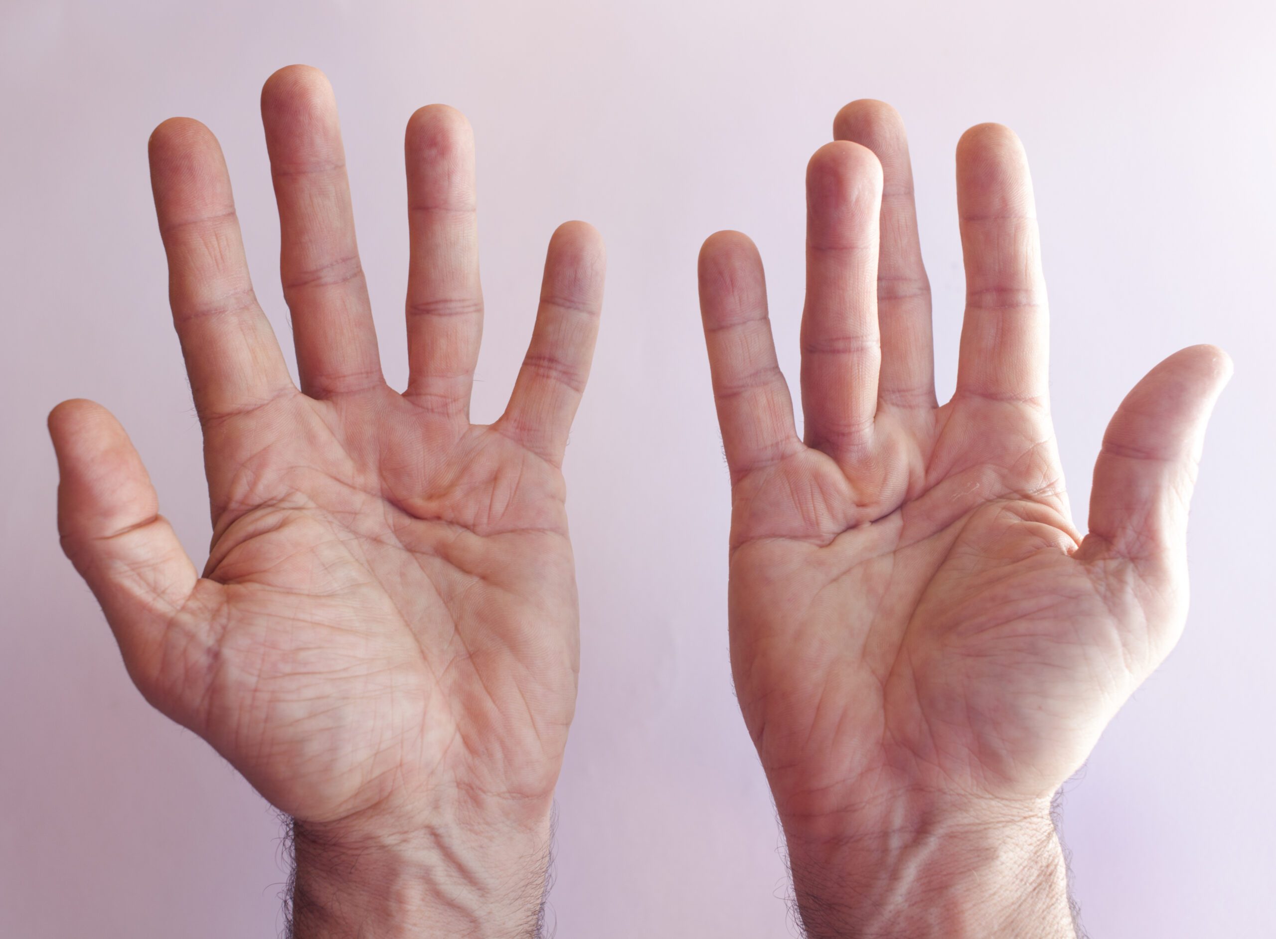 Understanding Dupuytren Problems: Causes, Symptoms, and Treatments