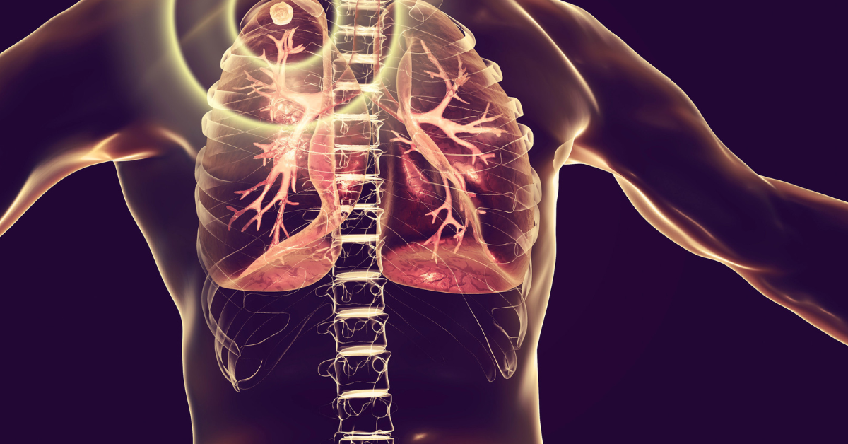 How is Tuberculosis Spread? Understanding the Transmission of TB