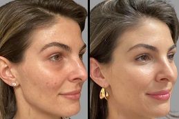 Before & After: Real Results from Chemical Peels