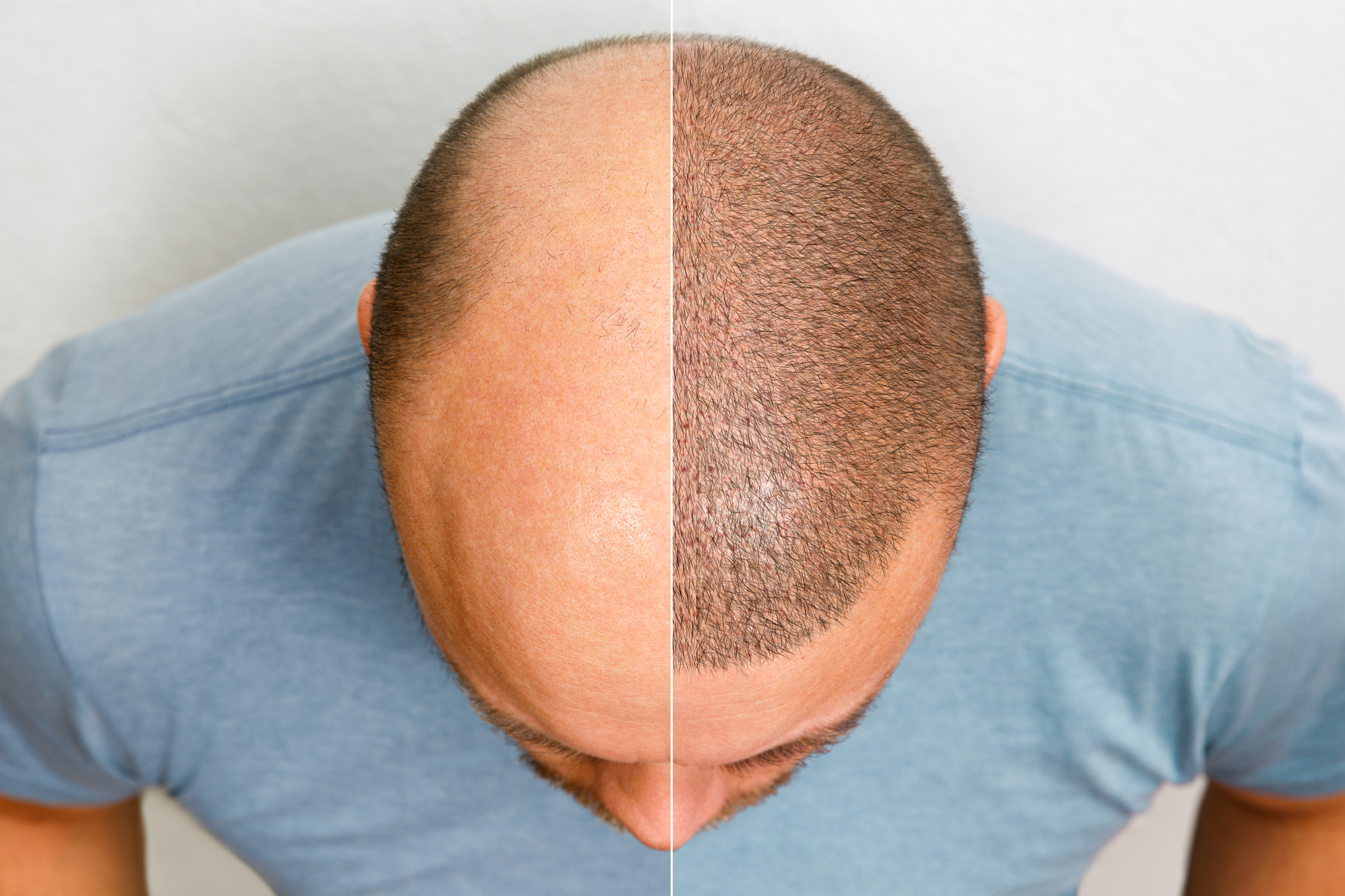 Success Stories: Hair Transplant Transformations in Islamabad