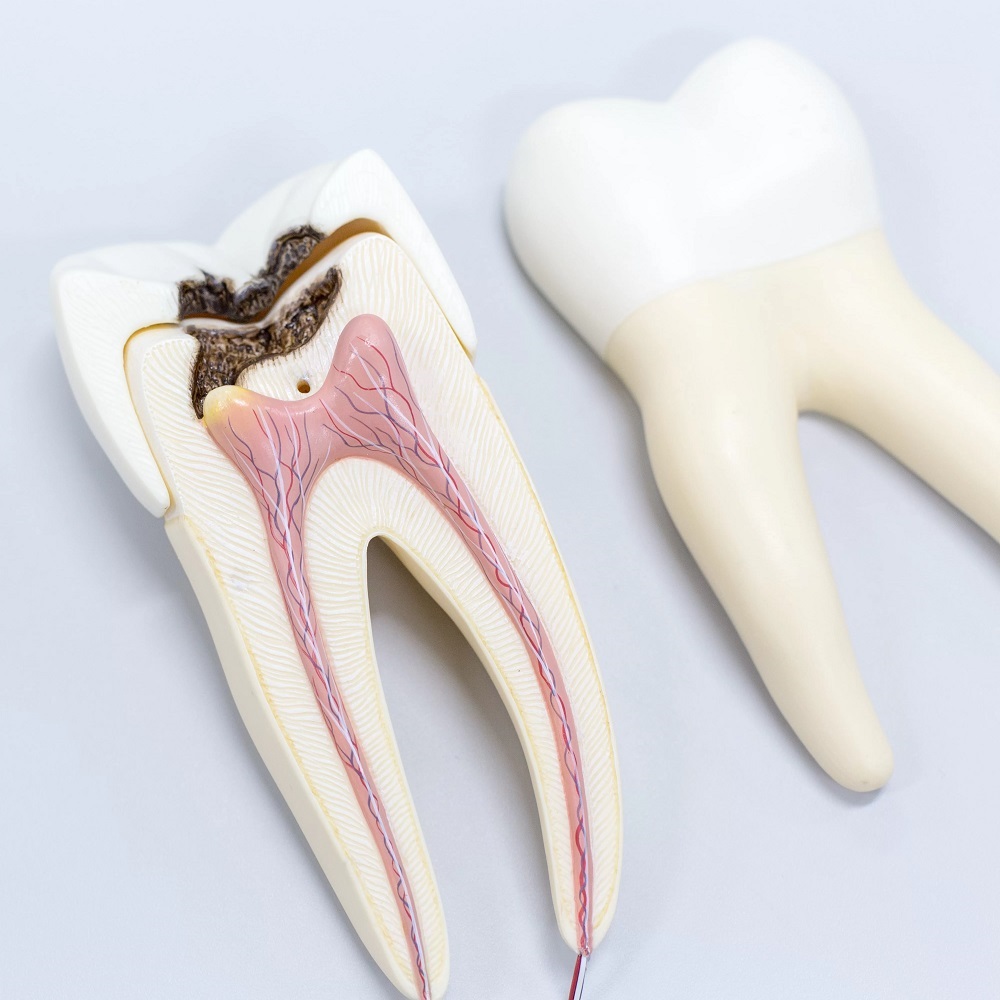 What Precautions Should You Take After a Root Canal?
