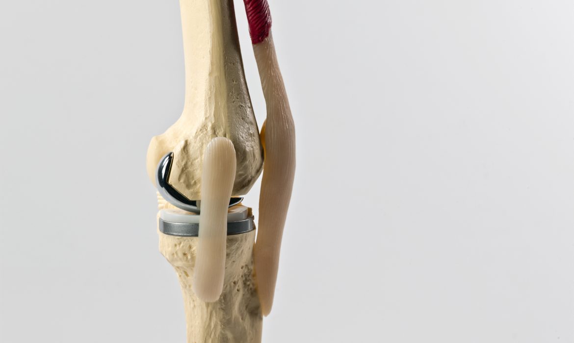 What to Expect During Knee Replacement in India?