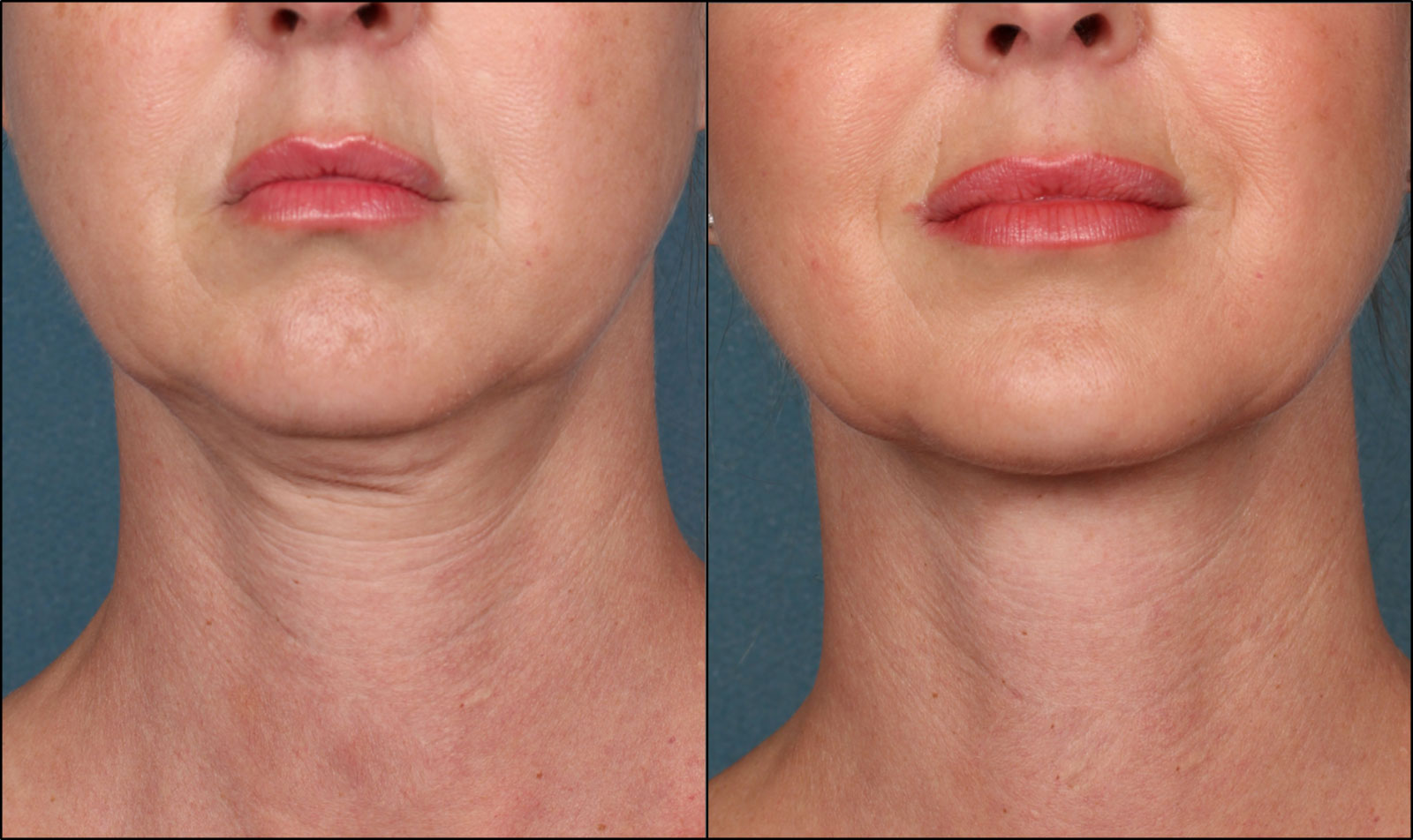 Morpheus8: The Breakthrough Treatment for Skin Tightening and Anti-Aging