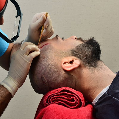 Are there any alternative surgery to a hair transplant?