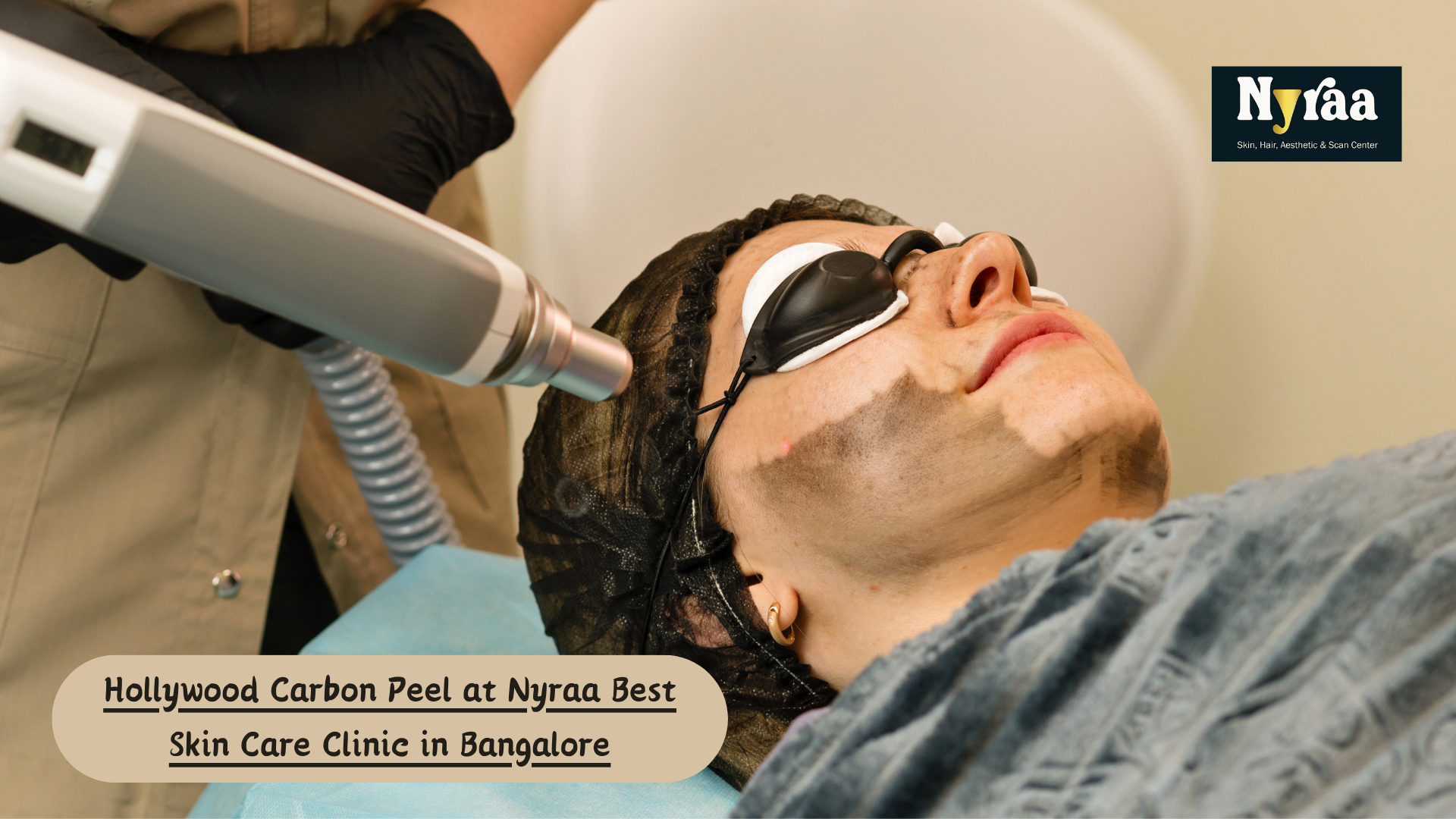 Hollywood Carbon Peel for Acne and Blackheads: Is It Effective?