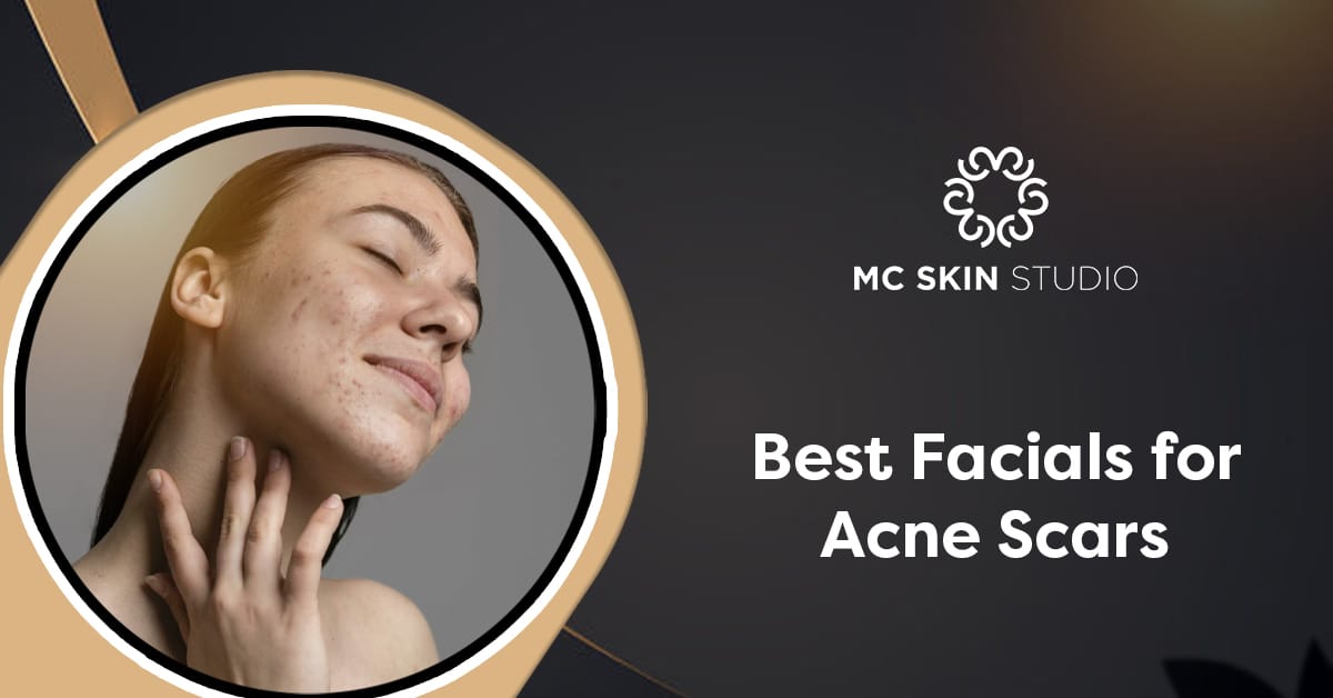 Best Facials for Acne Scars to Achieve Smooth, Clear Skin