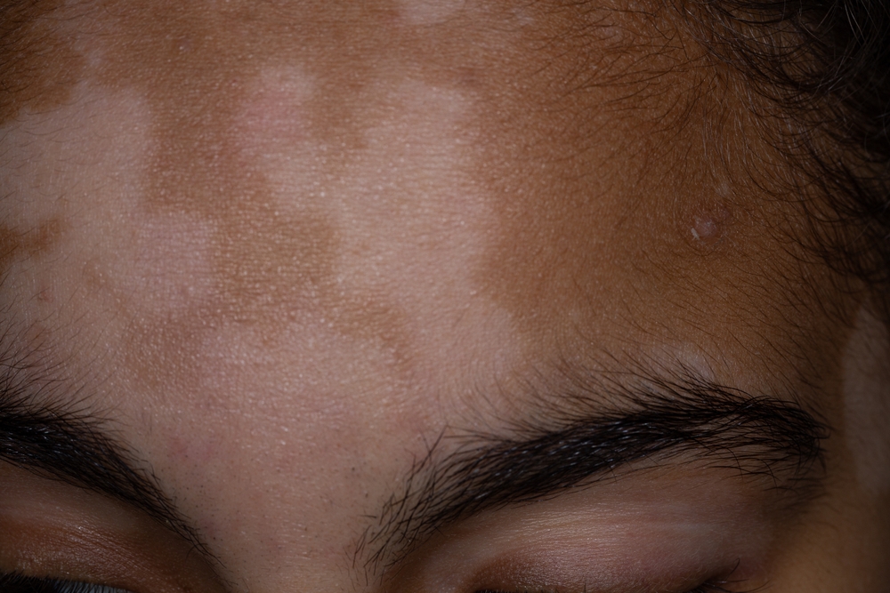 Hypopigmentation vs Vitiligo: Causes, Symptoms, and Treatment