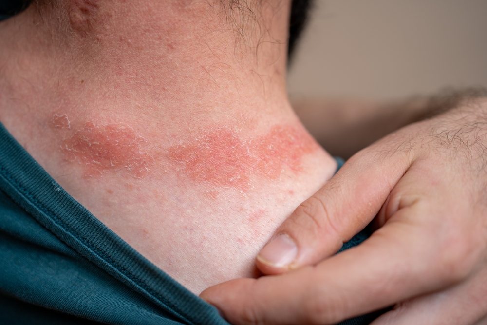 Psoriasis Triggers You Didn’t Know About: Unexpected Causes of Flares