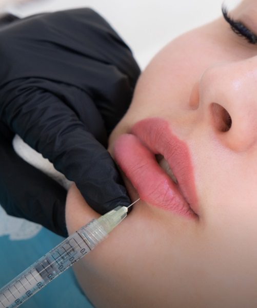 Top Lip Filler Injections in Dubai – Natural Results