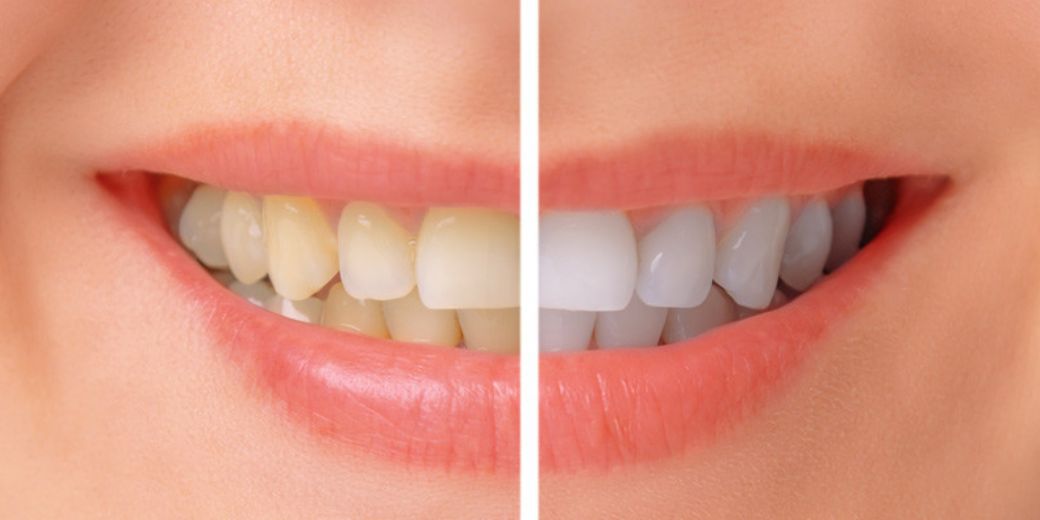 Teeth Whitening Treatments for a Bright, Confident Smile