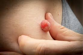 Skin tags in Riyadh : Why they develop, and how to remove them