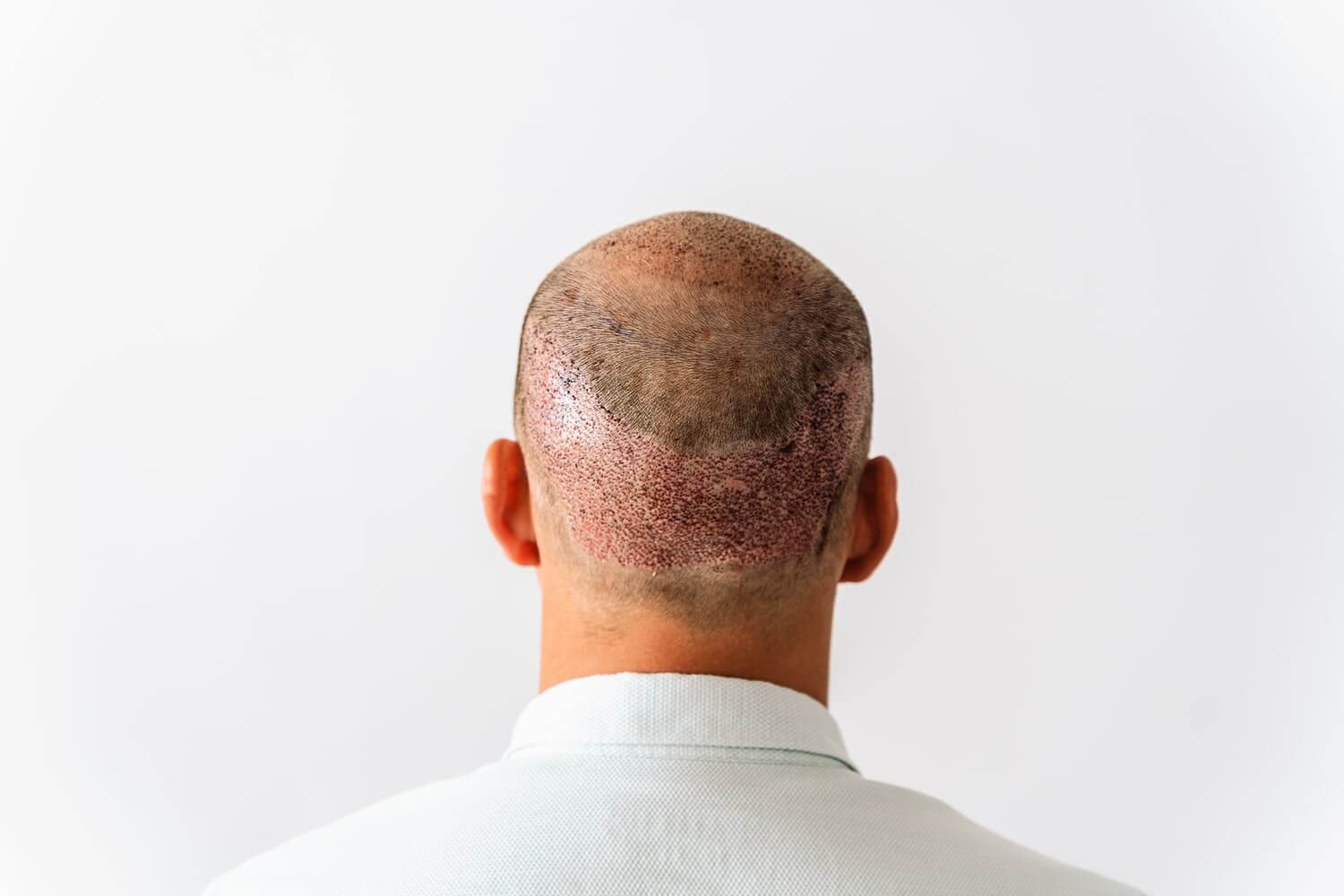 Post-Hair Transplant Care: Tips for a Smooth and Fast Recovery
