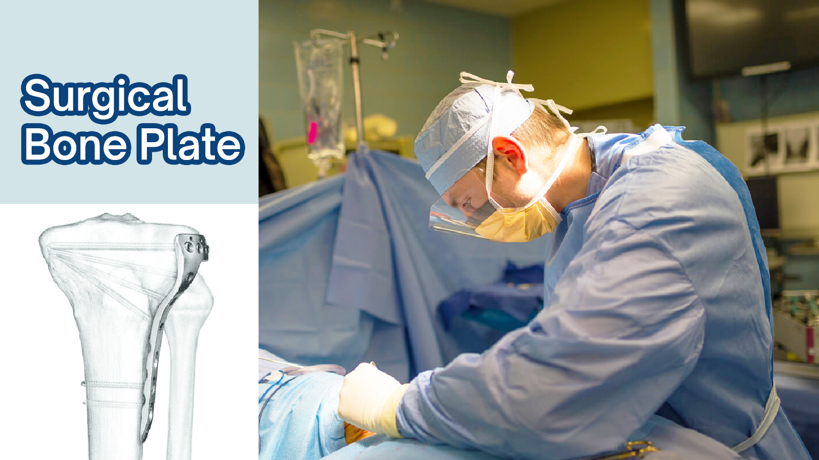 The Evolution of Surgical Bone Plate in Orthopedics