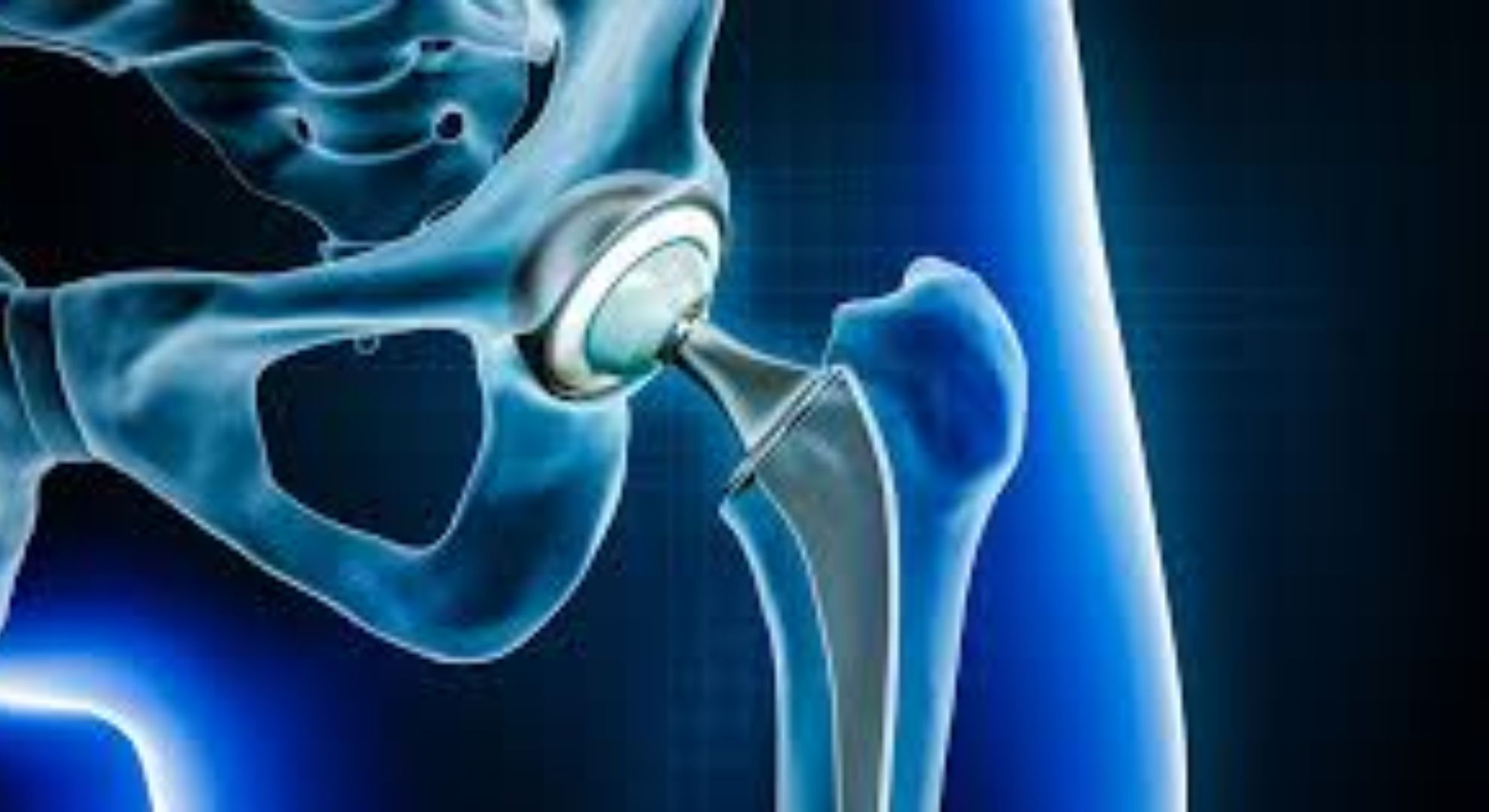 Understanding the Benefits of Hip Replacement Surgery