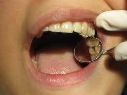 From Pain to Price: Understanding Root Canal Treatment Costs in Brisbane