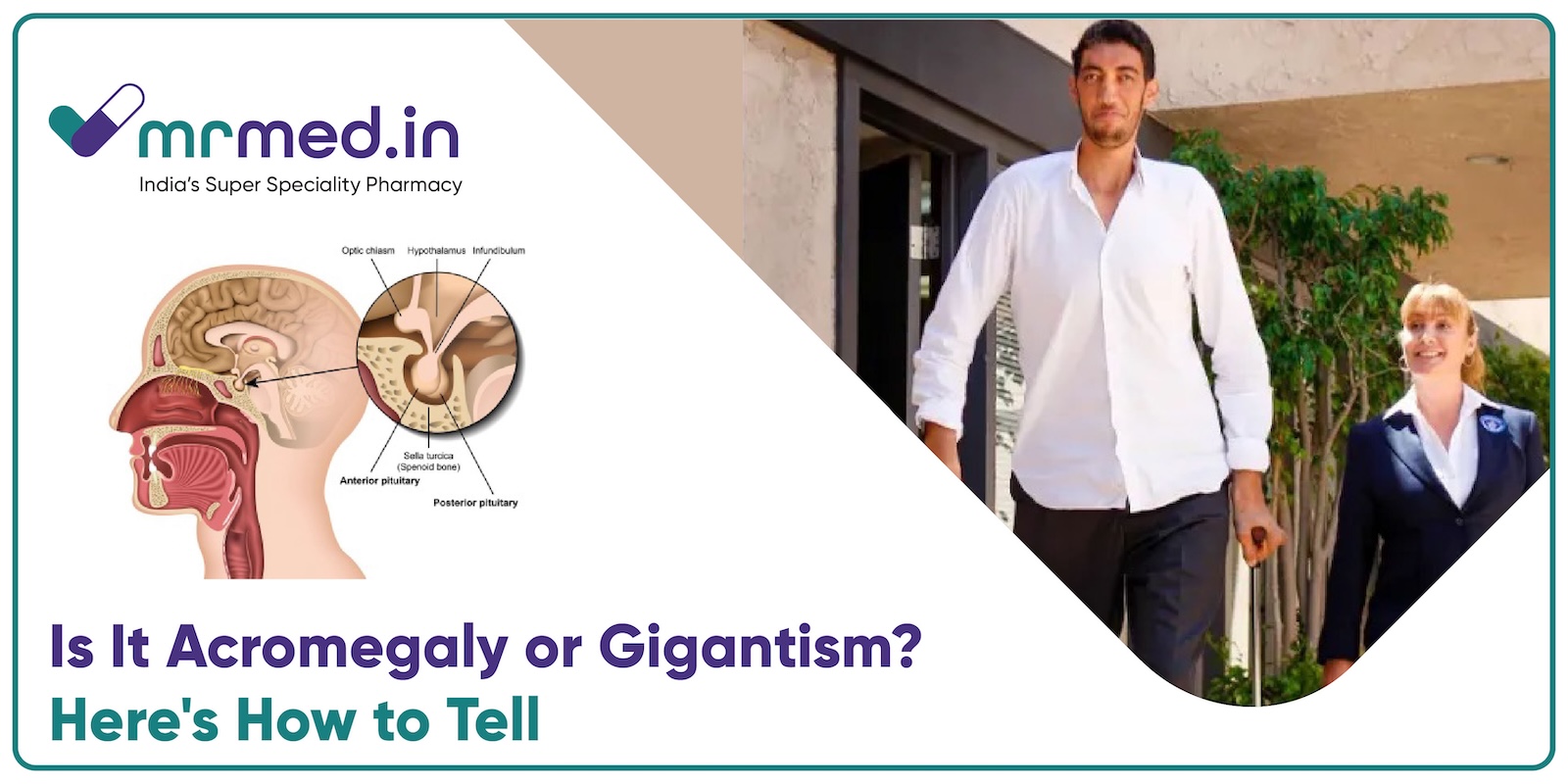 Acromegaly vs. Gigantism: What’s the Difference?