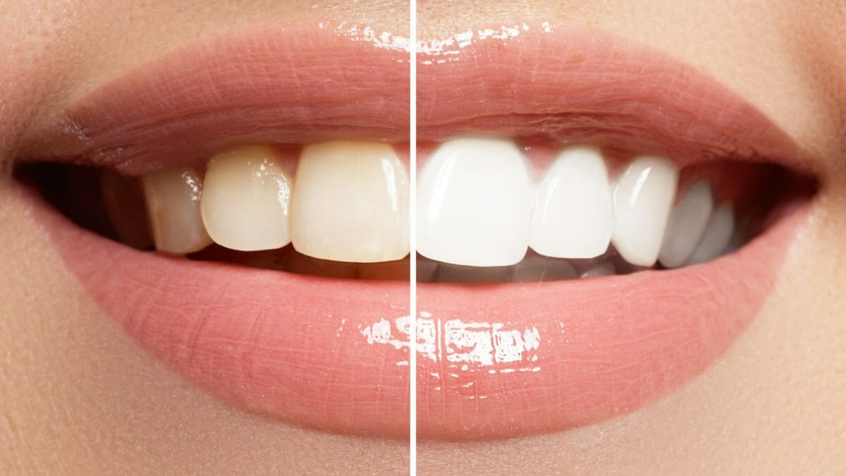 The Ultimate Guide to Teeth Whitening: Methods, Benefits, and Risks
