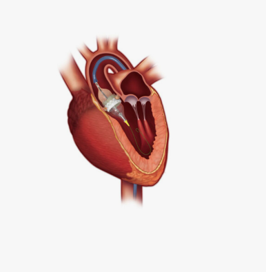 Transcatheter Heart Valve Replacement Market Size, Share, Growth & Industry Trends 2025