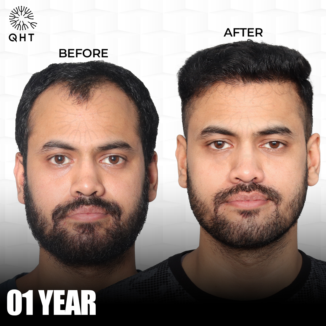 Understanding FUE Hair transplant Cost
