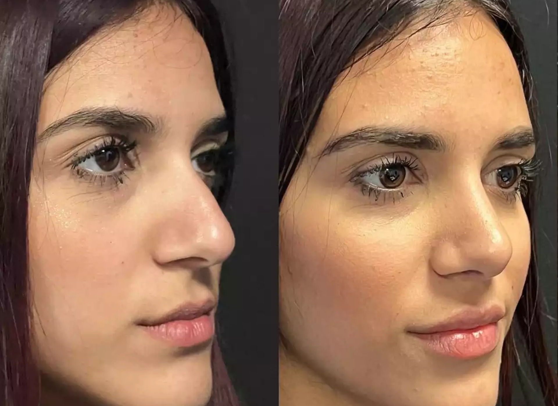 How the Best Septoplasty Surgeons in Dubai Use Technology to Improve Results