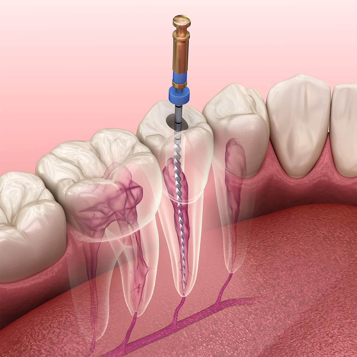 Root Canal Treatment vs. Tooth Extraction: Why Saving Your Tooth is Worth It