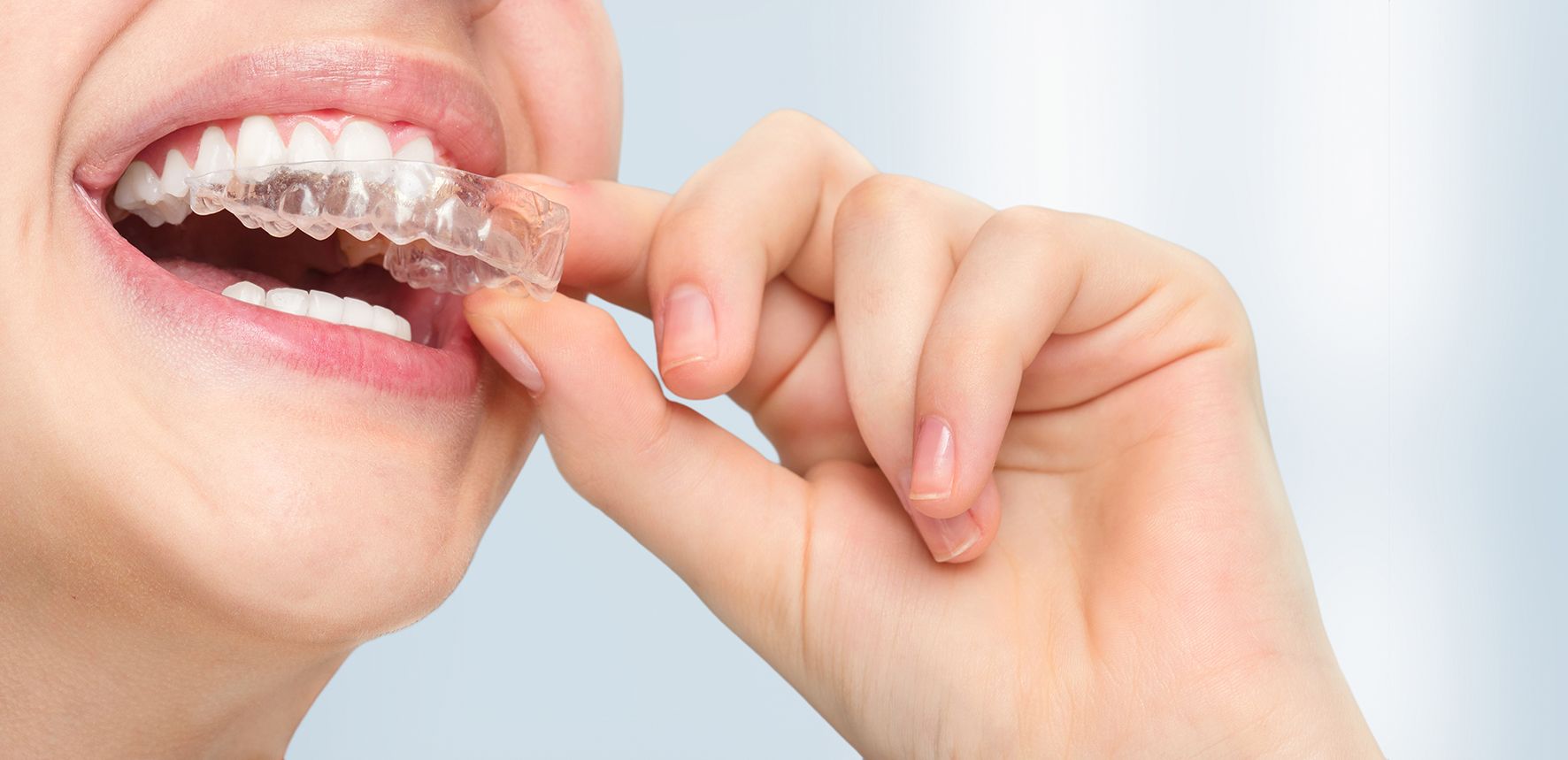 The Cost of Invisible Braces: Is It Worth the Investment?