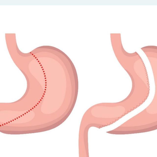 Your Guide to Gastric Sleeve Surgery in Riyadh
