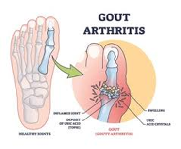 Gout vs. Arthritis: Key Differences You Should Know