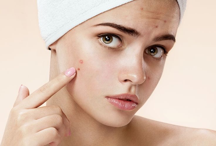 Why Teenagers in Islamabad Are Turning to Dermatologists for Pimples Treatment