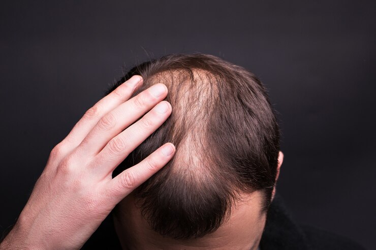 Hair Transplant Cost: Does Location Matter?