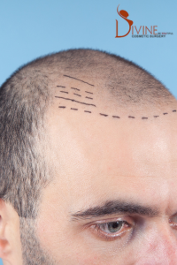 Restore Your Confidence with Expert Hair Transplant Services in Gurgaon, Lucknow, and Noida by Dr. Amit Gupta