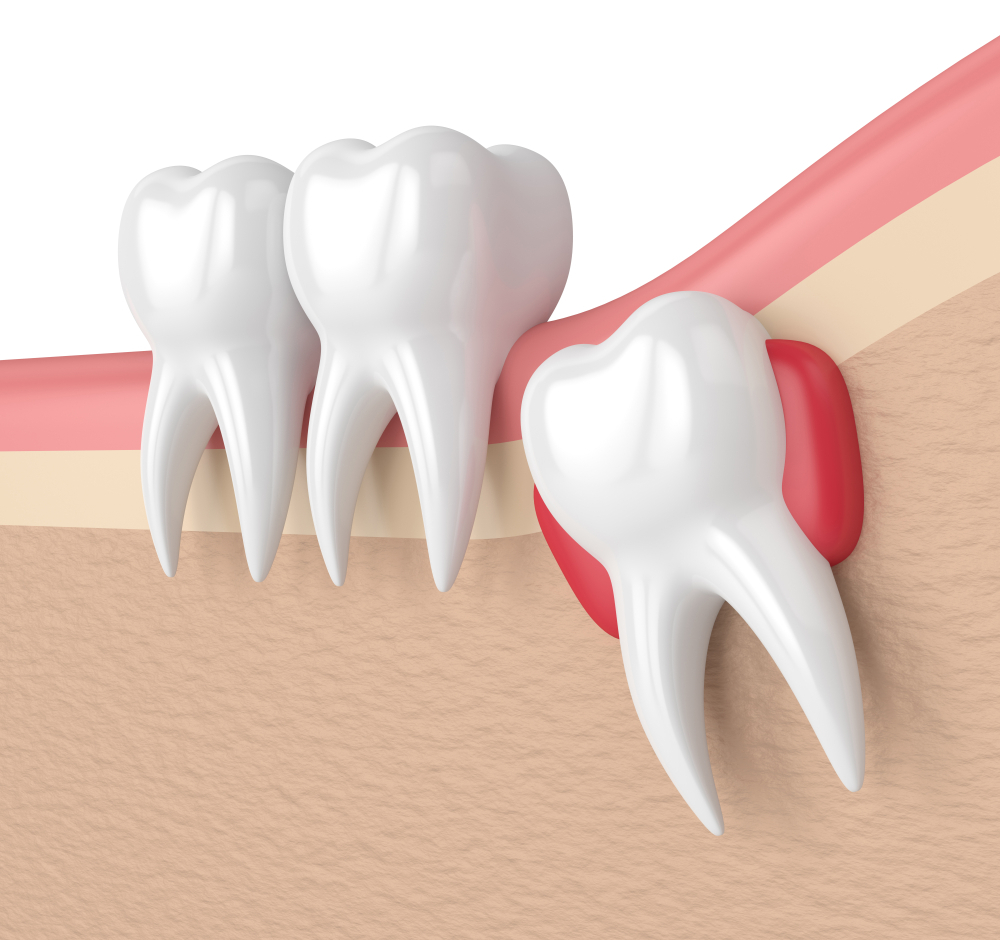Wisdom Teeth Recovery Made Easy: What to Do After Removal?