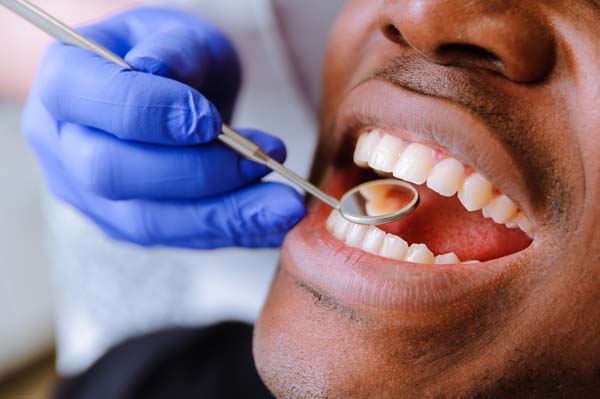 Oral Cancer: Early Signs, Prevention, and Treatment Options