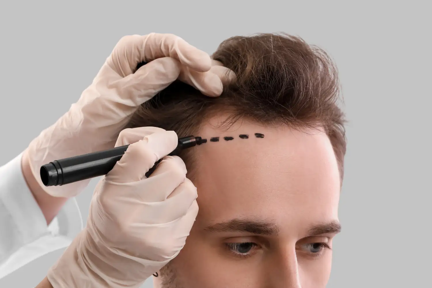 Affordable Hair Transplant Solutions in Islamabad