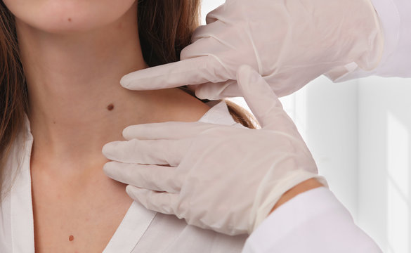 Skin Tag Removal Methods for Sensitive Skin