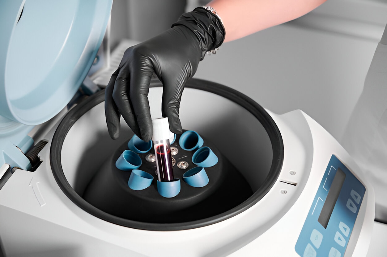 PRP Centrifuge: The Backbone of Effective Platelet-Rich Plasma Therapy
