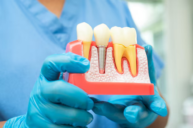 Are Same Day Dental Implants the Right Choice for You?